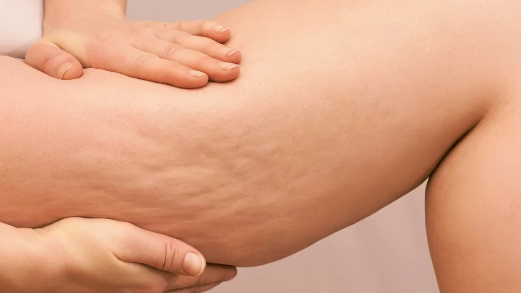 cellulite aqueuse